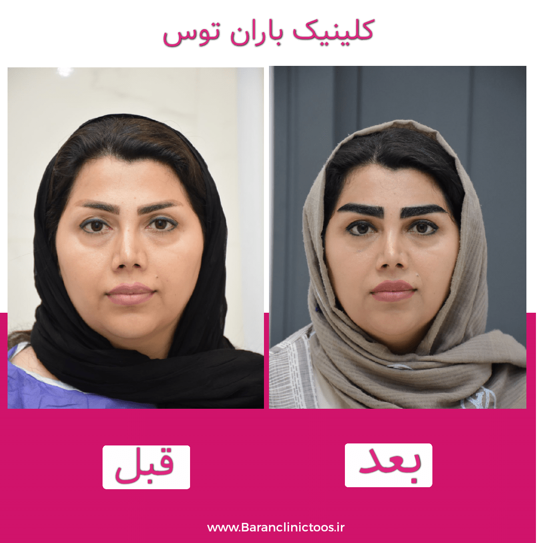 قبل و بعد کاشت ابرو